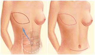 Breast Reduction Surgery, Pune, Cheap Aesthetic Surgery, Low Cost Aesthetic Surgery Services